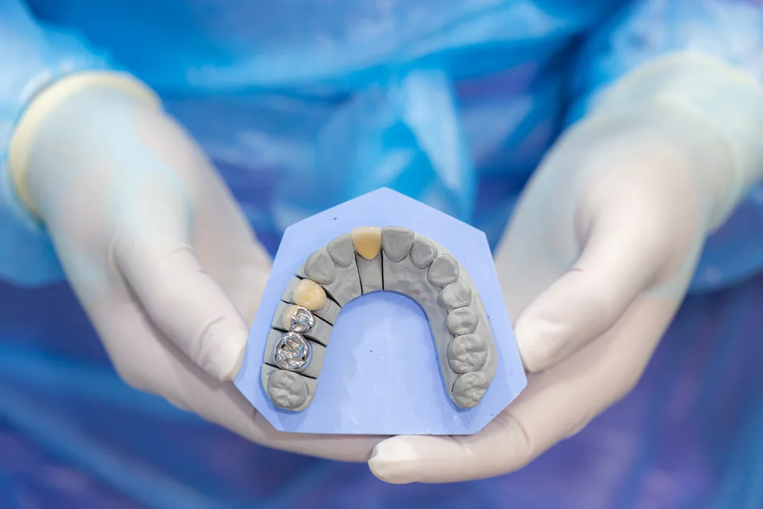 Dental Crowns