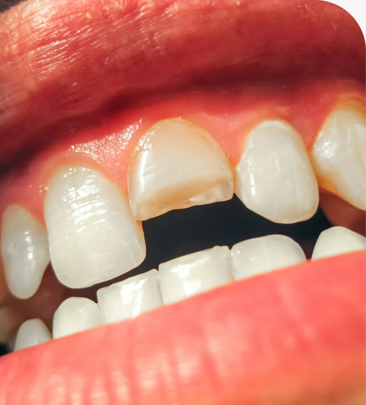 Dental Crowns in Twin Falls, ID